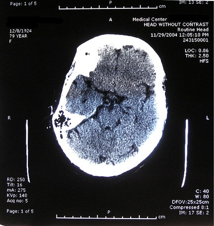 CT Scan from 11/29/04 showing missing portion of right hemisphere.